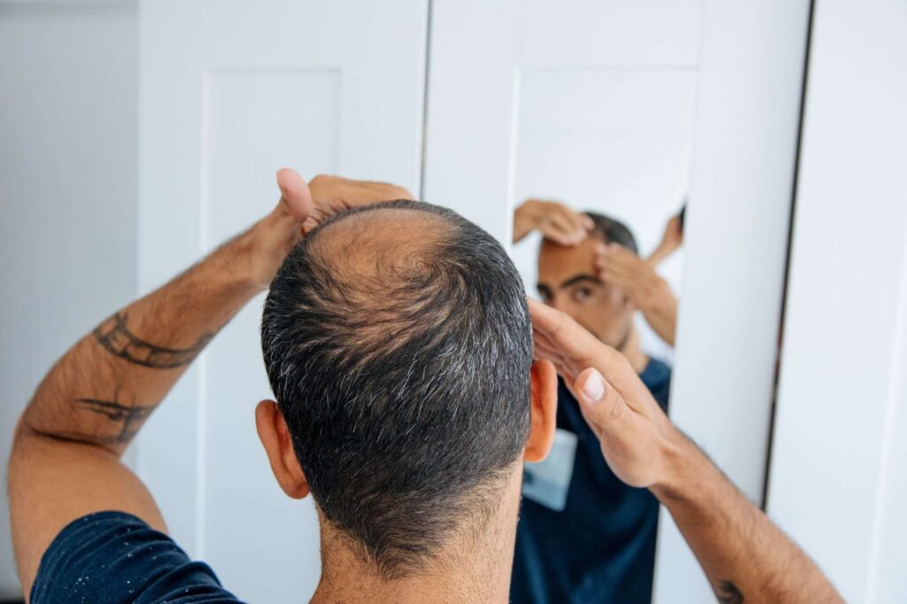 Are There Any Side Effects to Popular Hair Loss Medications?