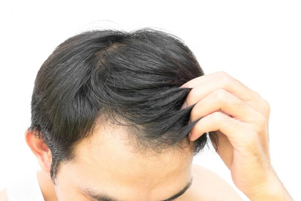 Can Natural Remedies Really Help in Regrowing Hair?