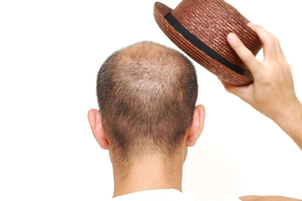 Can Wearing Hats or Using Styling Products Cause Hair Loss?