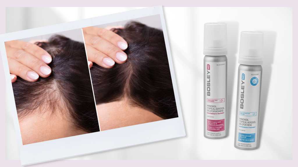 How Effective Is Minoxidil for Treating Hair Loss in Men and Women?