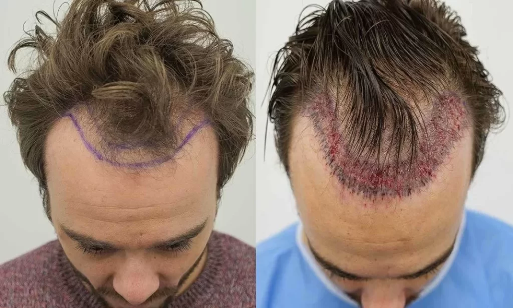 Is Hair Transplant Surgery a Permanent Solution for Baldness?
