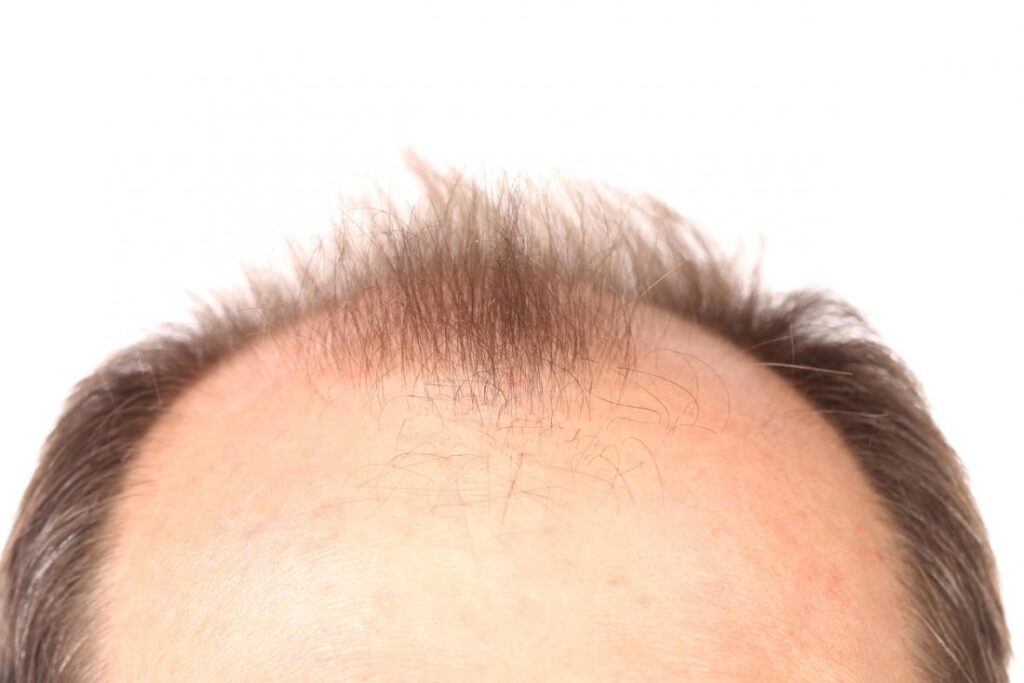What Advances in Research Are Being Made in Hair Loss Treatments?
