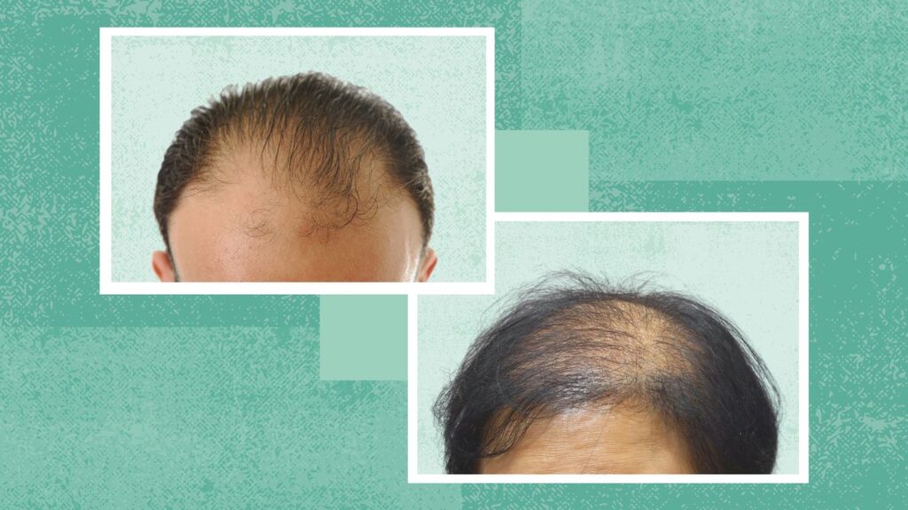 What Role Does Genetics Play in Male and Female Pattern Baldness?