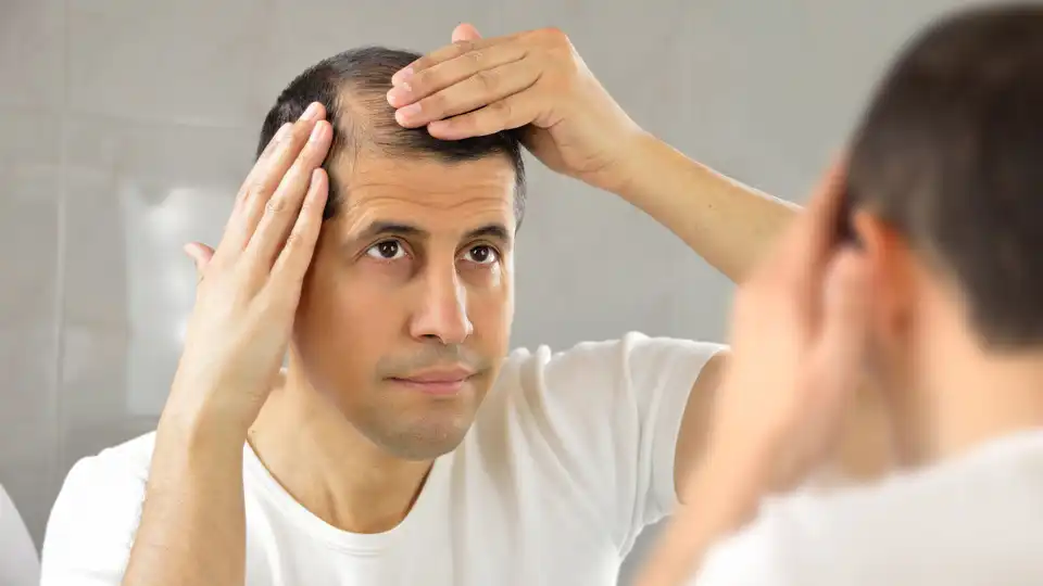 Male Pattern Baldness in Women