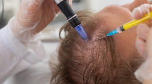 Exosome therapy treatment for hair loss regeneration