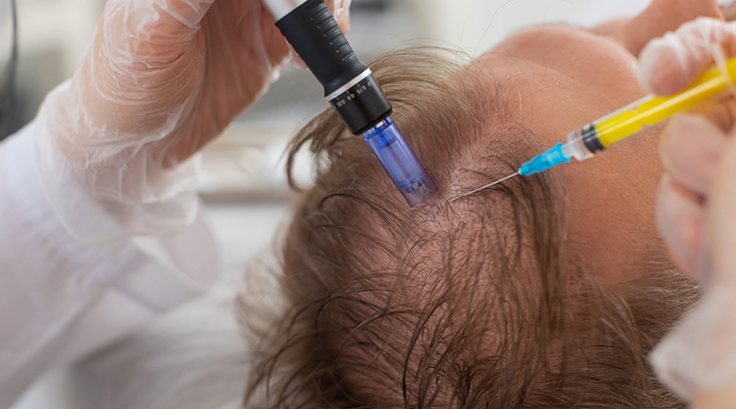 Exosome therapy treatment for hair loss regeneration