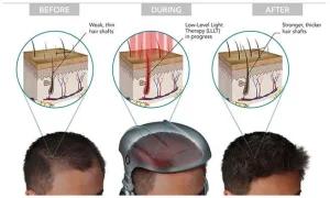 Low-level laser therapy device for hair loss treatment